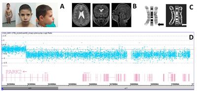 Developmental Coordination Disorder in a Patient with Mental Disability and a Mild Phenotype Carrying Terminal 6q26-qter Deletion